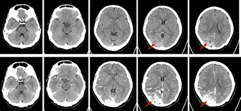 Image result for AVM Brain