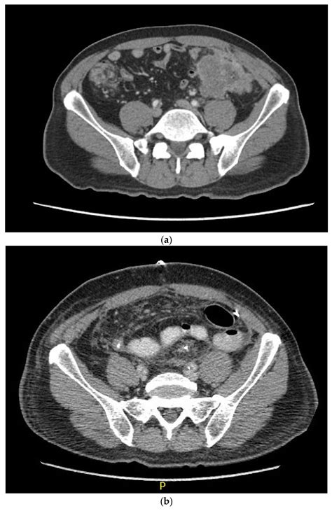 Double Duty: Complete Pathologic Response of Two Colonic Primaries with ...