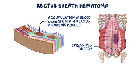 Rectus sheath hematoma: Clinical sciences - Osmosis Video Library