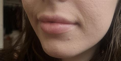 Migrated lip filler - dissolve? : r/PlasticSurgery