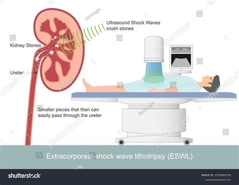 Lithotripsy Procedure 的图像结果