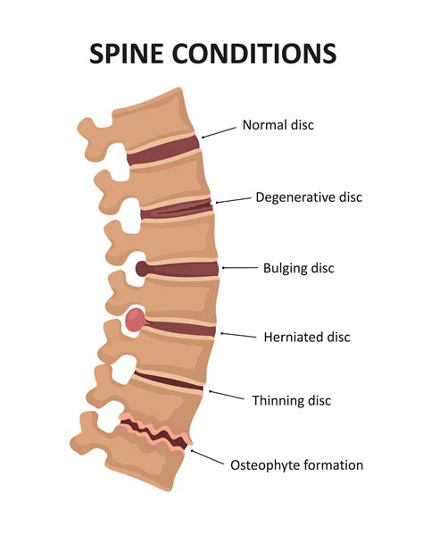 Lumbar Disc Disease Vs Degenerative Disc Disease at Victoria Brownlee blog