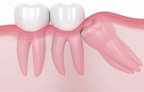 Image result for molar 牙齿