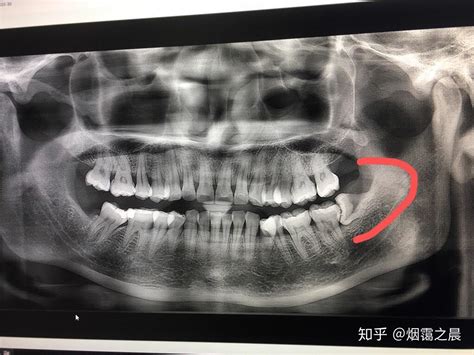 蛀牙到牙齒斷裂怎麼辦 - 牙齒矯正板 | Dcard