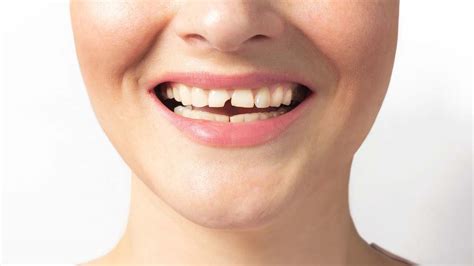 Image result for Broken Tooth