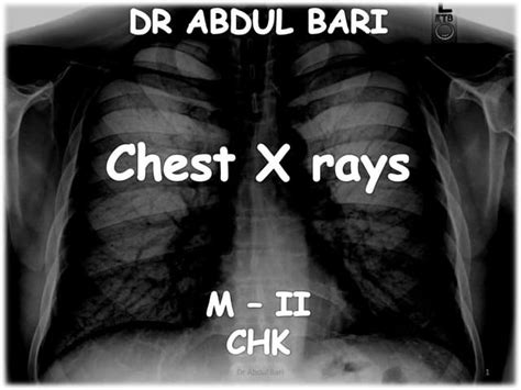Image result for Chest X-Ray Tutorial