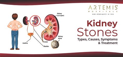 Congestive Heart Failure Stages: Symptoms, Causes & Diagnosis | Artemis ...