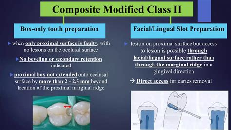 Class I , II Composites Cavity preparations | PPTX