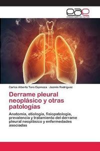 Derrame pleural neoplasico y otras patologias: Buy Derrame pleural ...