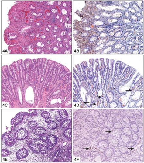 What are Inflammatory Polyps? – Pathosomes