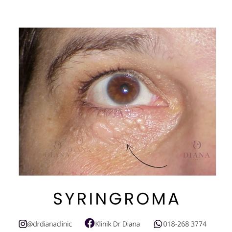 Cholesterol Bumps On Eyelids