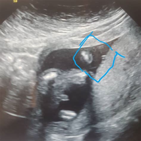 Signs Of A Bad Ultrasound