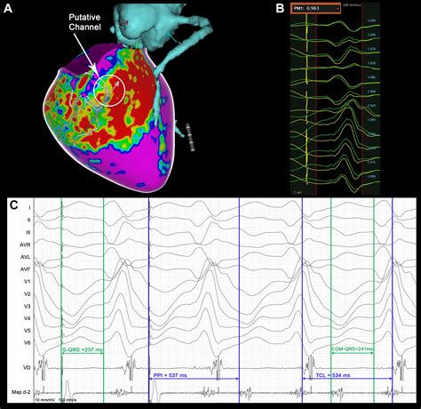 Cardiac Magnetic Resonance and Segment of Origin Identification ...