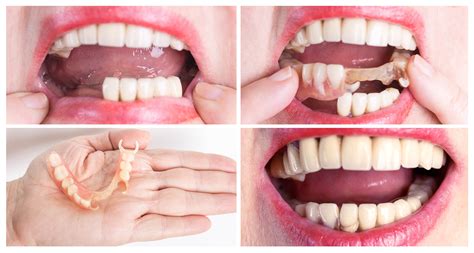 Dentures Before And After Pictures | What To Expect