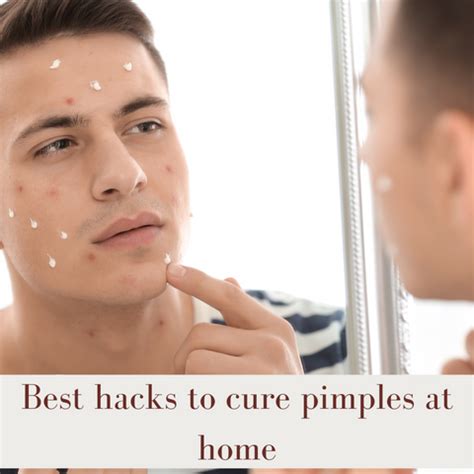 8 Doctor Tips to Cure Pimples at Home (Without Scarring) | Clinikally