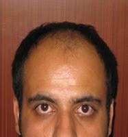 Before and After Photos - Case B010