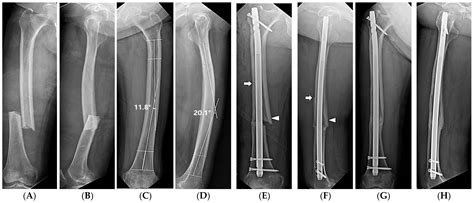 Risk Factors Associated with Intraoperative Iatrogenic Fracture in ...