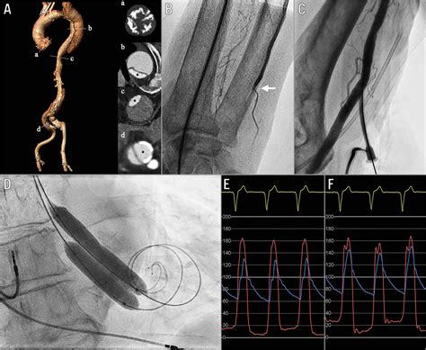 Balloon aortic valvuloplasty with two simultaneous balloons via ipsilateral transradial and ...