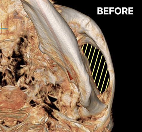 Image result for Cheekbones Reduction Book