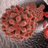 Hepatitis A and its Treatment