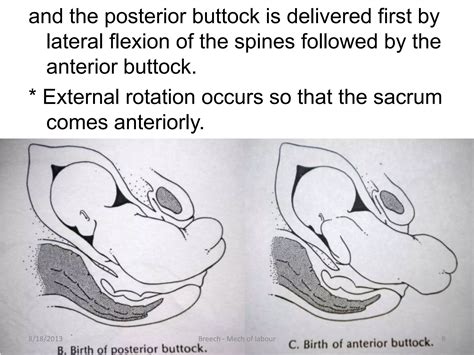 Mechanism Of Breech Presentation
