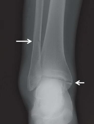 Trimalleolar Ankle Fracture | Radiology Key