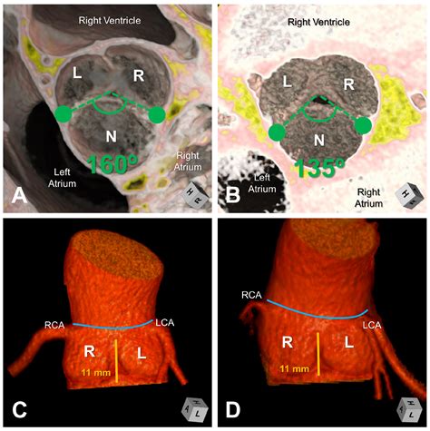 Impact of Variation in Commissural Angle between Fused Leaflets in the ...
