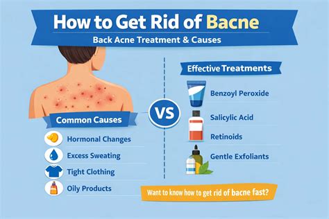 How to Get Rid of Bacne: Causes and Effective Treatments