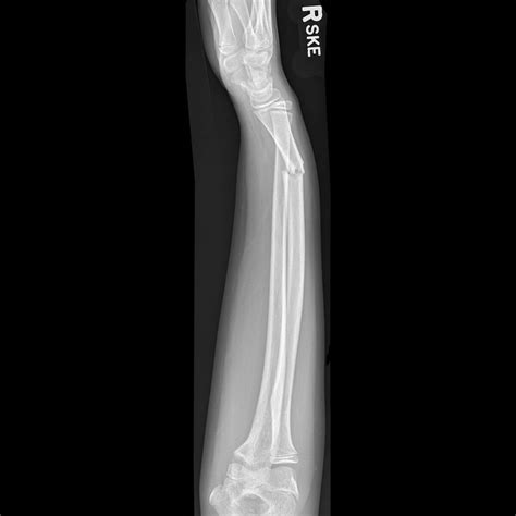 Radius Fracture Ulna Dislocation at Sophia Wiseman blog