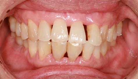 4 Reasons Why You Should Not Brush For More Than 2 Minutes - lifeberrys.com