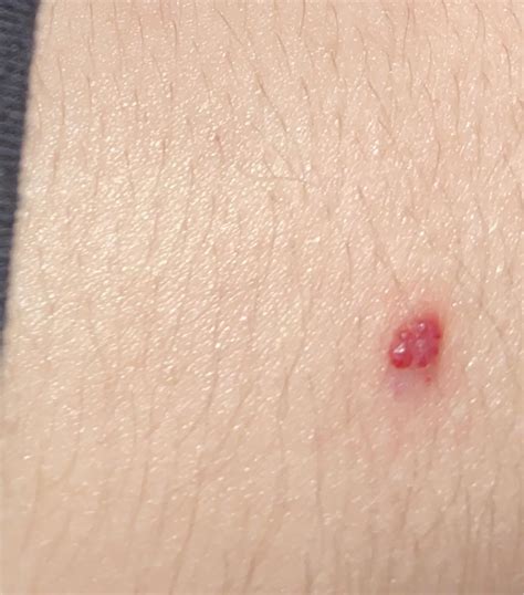 long term popped blood vessel : r/AskMedical