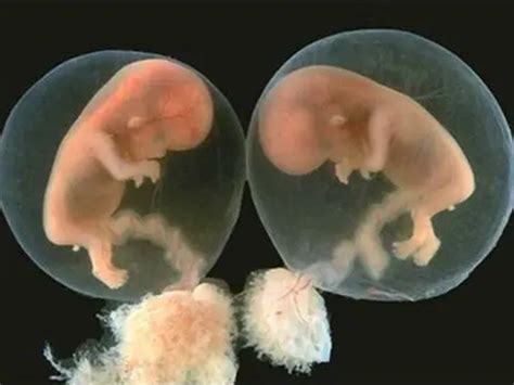 孕21周单绒双羊双胞胎发育有差距会是双胎输血症吗?_家庭医生在线