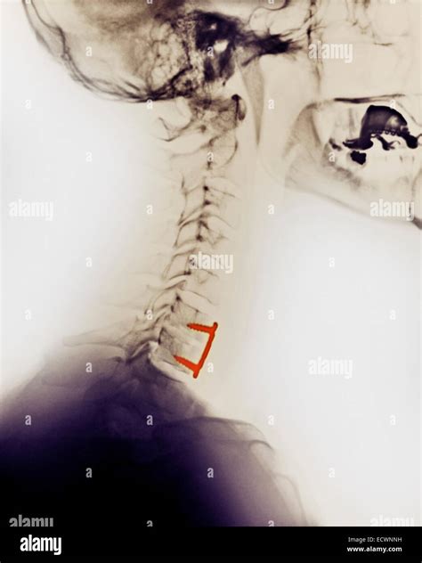 Neck Fusion High Resolution Stock Photography and Images - Alamy