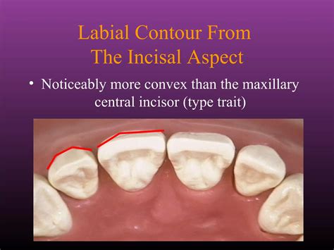Maxillary Lateral and Mandibular Incisors | PPT