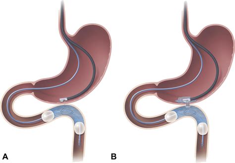 Supplemental Materials for Novel EUS-guided gastrojejunostomy technique ...