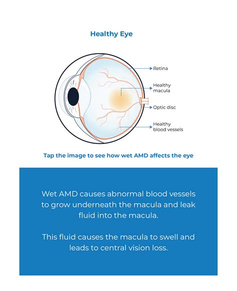 WAMD - Wet Age Related Macular Degeneration - Kodiak Sciences