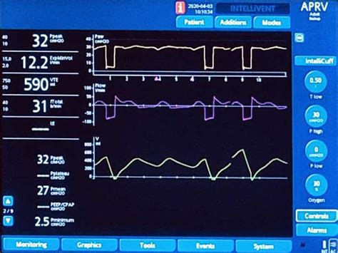 APRV Mode Explained 的图像结果