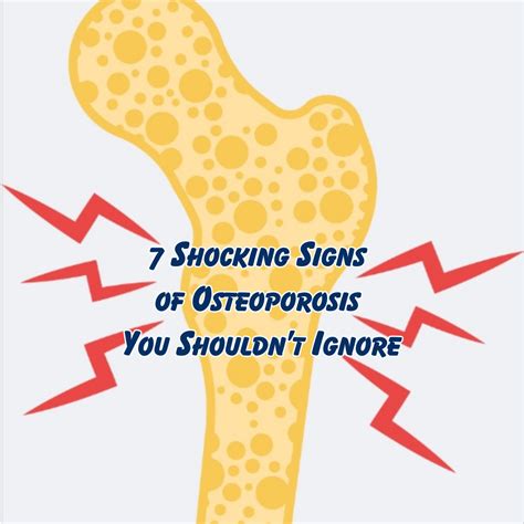 7 Shocking Signs of Osteoporosis You Shouldn’t Ignore
