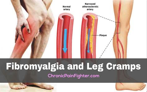 Fibromyalgia and Leg Cramps - Chronic Pain Fighter