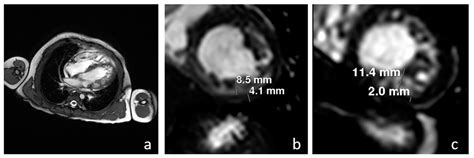 Unusual Evolution of Hypertrophic Cardiomyopathy in Non-Compaction Myocardium in a Pompe Disease ...
