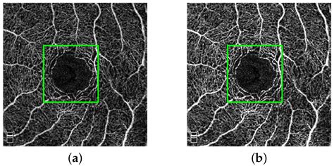 Retinal OCTA Image Segmentation Based on Global Contrastive Learning