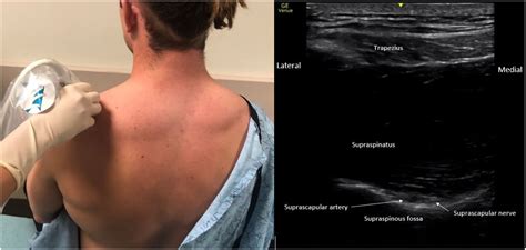 Successful Glenohumeral Shoulder Reduction With Combined Suprascapular ...