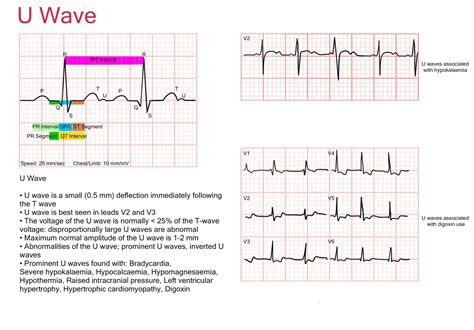 Basic ECG Illustrations – International Emergency Medicine Education ...