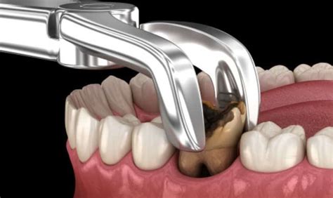 Image result for Tooth Extraction Pictures