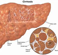 Liver cirrhosis 的图像结果