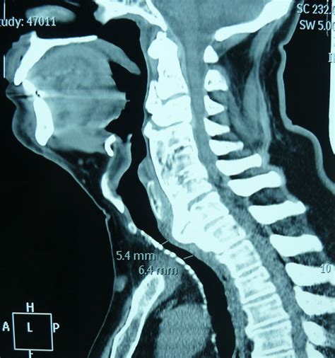 What Causes Osteophytes In Cervical Spine - Infoupdate.org