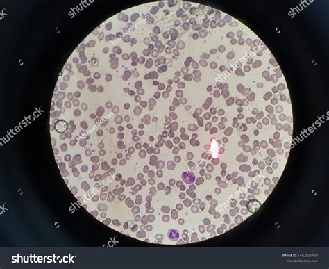 Hypochromic Microcytic Anisopoikilothermia Burr Cell Acanthocyte Stock ...