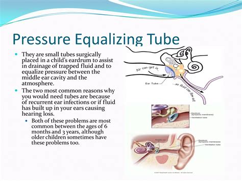 Pressure Equalization Tube