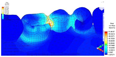 Inlay-Retained Dental Bridges—A Finite Element Analysis
