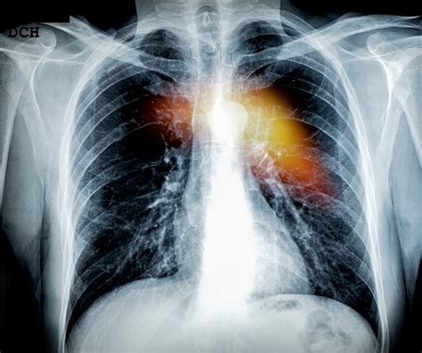 Este es el primer síntoma de cáncer en los huesos